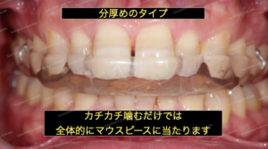 マウスピース分厚めのタイプ　スタビライゼーションスプリント　カチカチかむと全体的にあたります